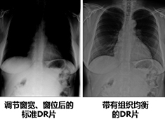 影響醫(yī)用X射線影像設備成像質量的主要指標和因素